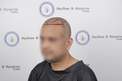 hair line marking