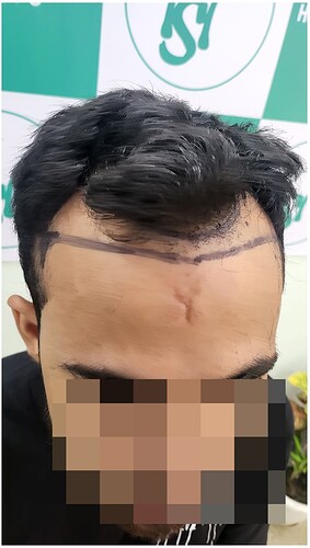 Before Hair Transplant HS 815 - The Hairsmith Clinic Delhi India - (2)