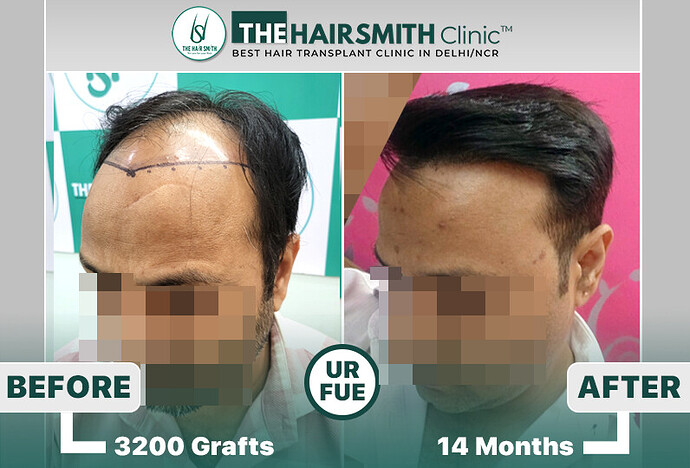 the hairsmith clinic hair transplant result #hairtransplant #hairsmithhairtransplant #hairregrowth
