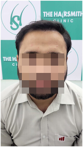06 months hair transplant result - the hairsmith clinic delhi ncr india - 1