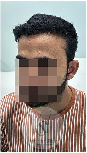 After 11 months hair transplant result update - the hairsmith clinic 4