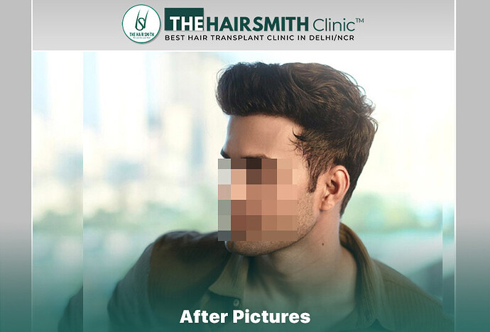 best hair transplant result #hairtransplant #thehairsmithclinic #hairsmithhairtransplant