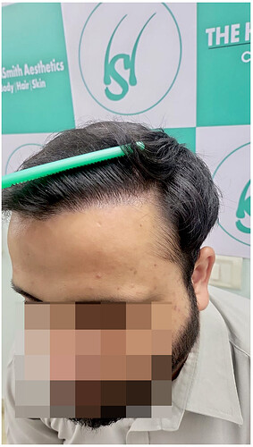 06 months hair transplant result - the hairsmith clinic delhi ncr india - 2