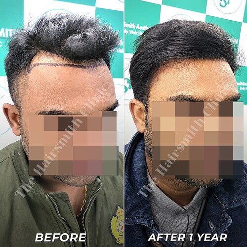 Hairsmith Hair Transplant Result - After 1 year  Update (4)