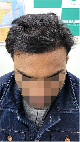 After 1 years hair transplant result update at the hairsmith clinic delhi india (5)