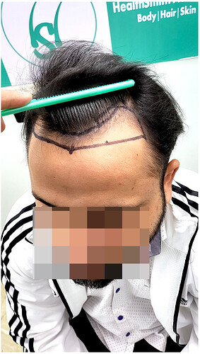 Before Hair Transplant HS 828- The Hairsmith Clinic Delhi India - 4