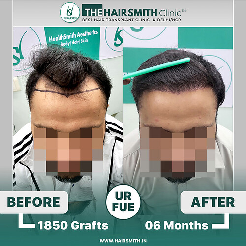 the hairsmith hair transplant result - 06 months update - 3
