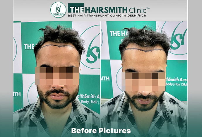 best hair transplant in delhi - the hairsmith clinic