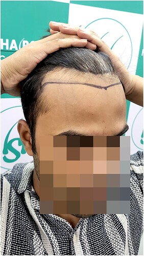 Before Hair Transplant HS823- The Hairsmith Clinic Delhi India (c)