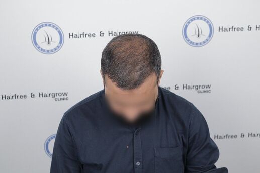 after 4 month hair transplant result