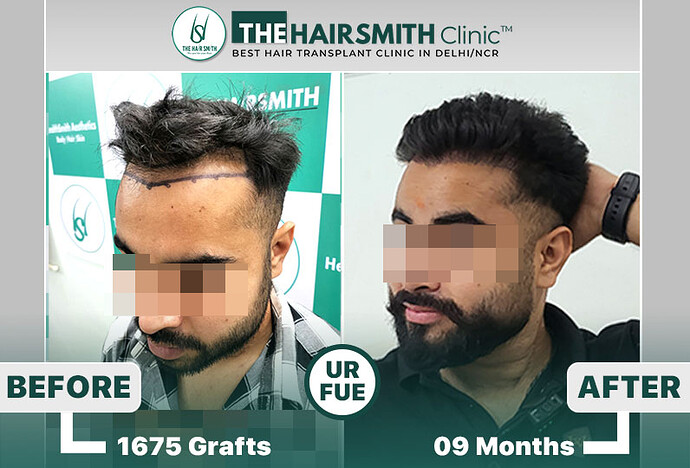 best hair transplant clinic in india - after 9 months result - the hairsmith clinic