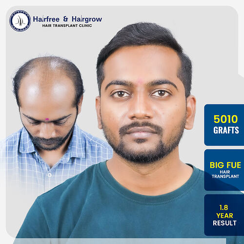 ankit-sawant-hair-transplant-result-india-5010-grafts-big-fue-1.8-year.jpg