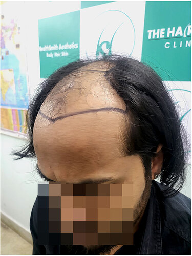 Before Hair Transplant HS 829- The Hairsmith Clinic Delhi India 4
