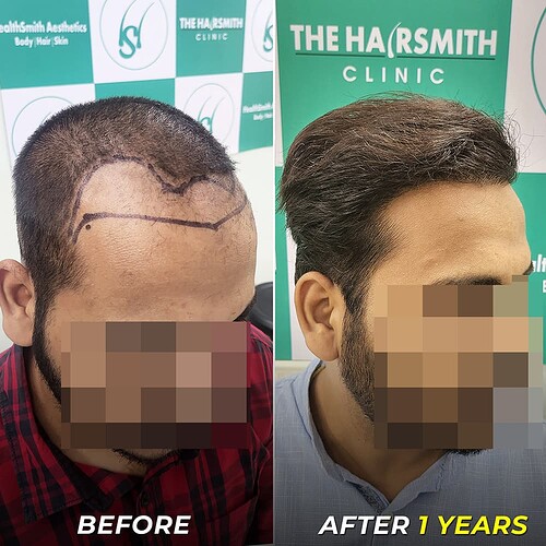 Hair Transplant Result After - 1 Years - The Hairsmith Clinic Delhi (3)