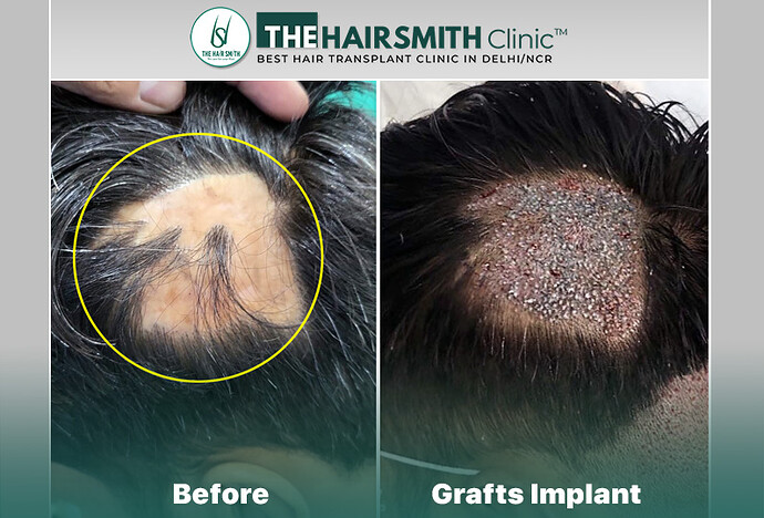 Grafts Implant - urfue technique - hairsmith hair transplant