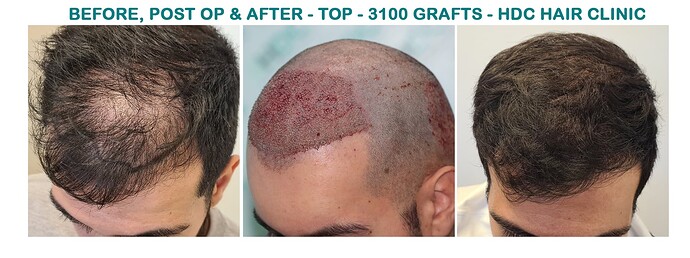 HT 20-02-24 for 3100 Grafts Set 2