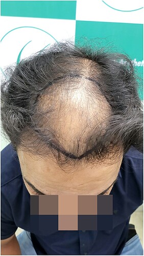 Before Hair Transplant HS 813 - The Hairsmith Clinic Delhi India - 3