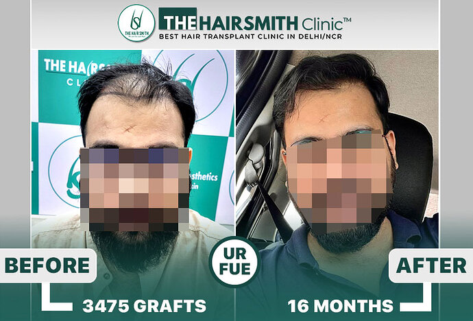 The Hairsmith Hair Transplant Results #HairTransplant #HairTransplantResult