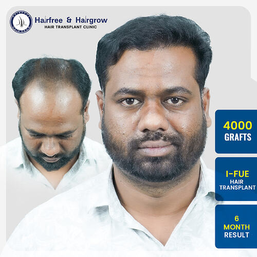 rahul-mankar-4000-grafts-i-fue-hair-transplant-6-month-result-pune.jpg