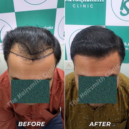 Best Hair Transplant Result - After 10 Months Update - The Hairsmith Clinic Delhi India - 2