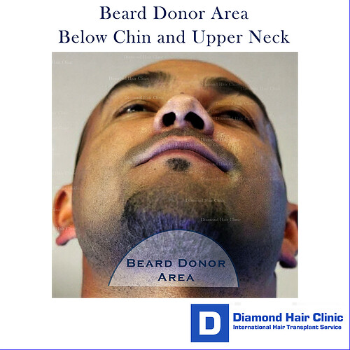 Beard Donor Area