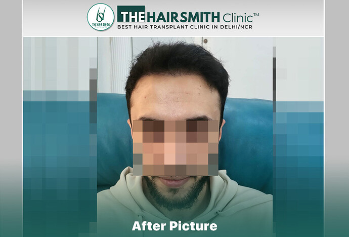 8 months hairsmith hair transplant result - the hairsmith clinic delhi #hairtransplant