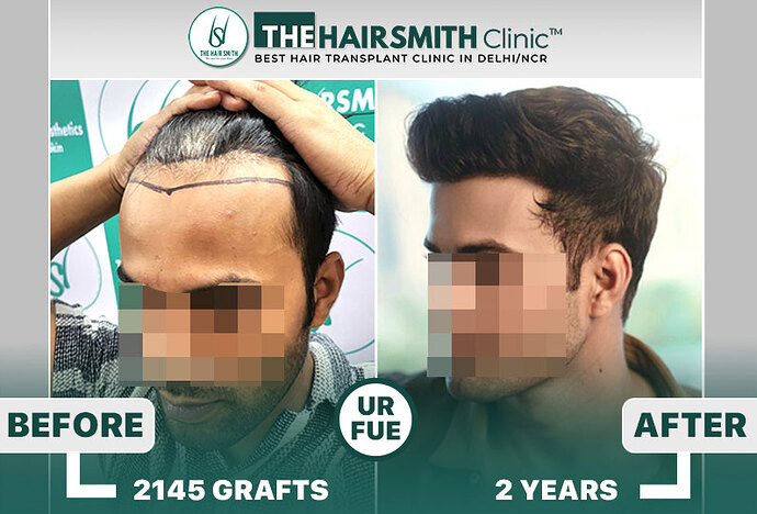 best hair transplant results in india #thehairsmithclinic #hairsmithresults #hairsmithhairtransplant