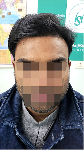 After 1 years hair transplant result update at the hairsmith clinic delhi india (2)