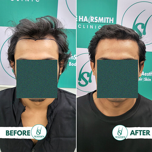 Hairline Hair Transplant Result After 6 months update - The Hairsmith Hair Transplant Clinic.PNG