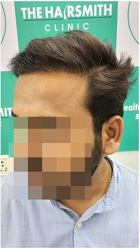 After Hair Transplant Result - The Hairsmith Clinic (3)