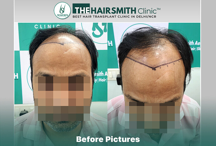 Before Hair Transplant HS 843- The Hairsmith Clinic Delhi India - #hairtransplant
