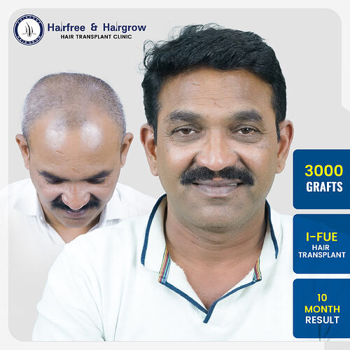 rajendra-dhamale-3000-grafts-hair-transplant-10-month-mid-scalp-result-pune.jpg