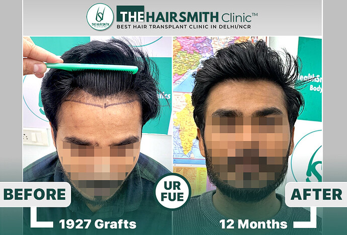 #hairtransplant #hairtransplantresult #hairtransplantclinicdelhi #thehairsmithclinicdelhi