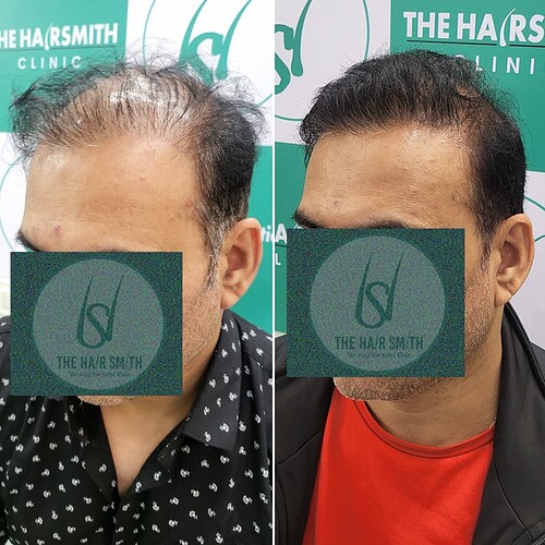 Best Hair Transplant Result Picture 5 - The Hairsmith Hair Transplant Clinic