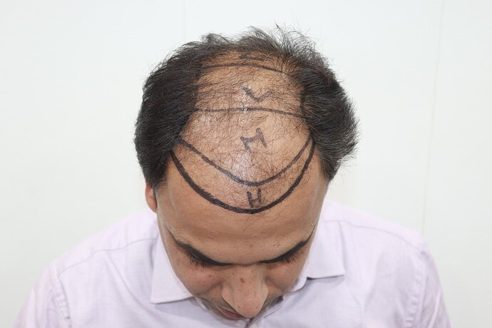 Hair line marking