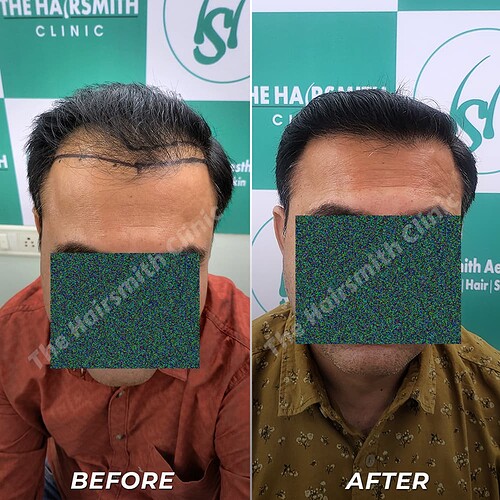 Best Hair Transplant Result - After 10 Months Update - The Hairsmith Clinic Delhi India - 1