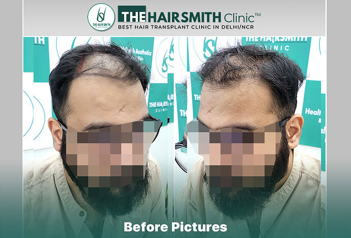 Before Hair Transplant HS 838- The Hairsmith Clinic Delhi India - #hairtransplant #norwoodstage5