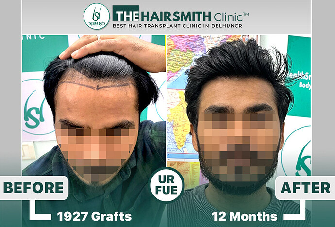 #fuehairtransplant #hairsmithhairtransplantresults #besthairtransplantindia #thehairsmithclinicdelhiindia