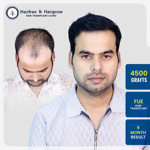 javed-sakla-hair-transplant-result-pune-4500-grafts-fue-9-month.jpg