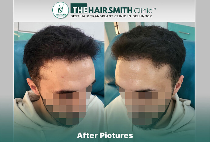 8 months hairsmith hair transplant result - the hairsmith clinic delhi #hairtransplant #thehairsmithclinic
