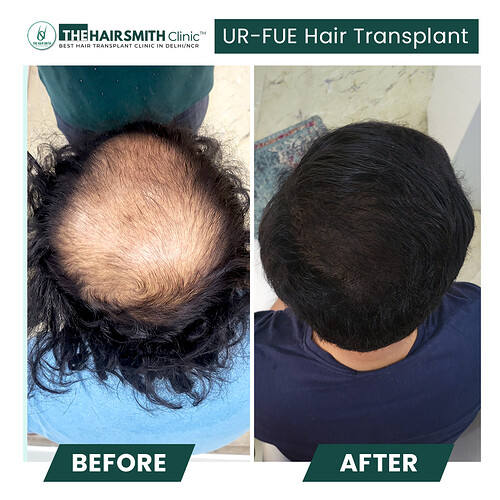 Amazing hair transplant result cp 2 - the hairsmith clinic