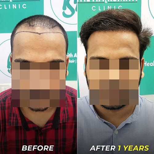 Hair Transplant Result After - 1 Years - The Hairsmith Clinic Delhi (1)