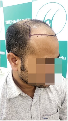 Before Hair Transplant HS 814 - The Hairsmith Clinic Delhi India - 4