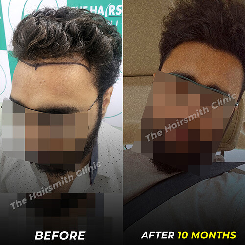Hair Transplant Result in 10 Months - Before-After - The Hairsmith Clinic 3