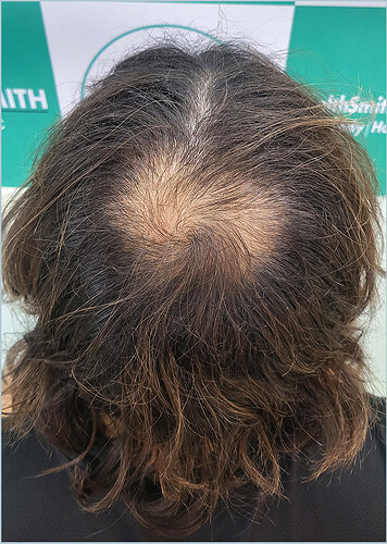 Before Hair Transplant HS 818 - The Hairsmith Clinic Delhi India - image 1