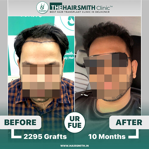 The Hairsmith Hair Transplant Result - before and after -  2