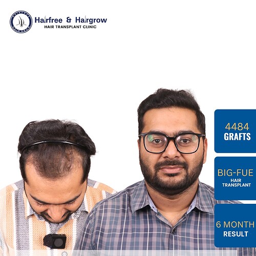 hair-transplant-4484-grafts-6-month-result-pune