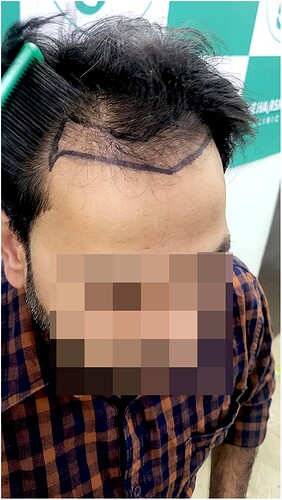 Before Hair Transplant HS 827- The Hairsmith Clinic Delhi India - 3