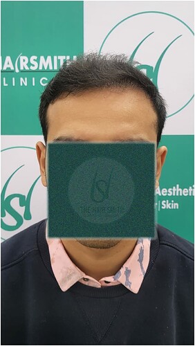 After Hair Transplant Result (1)  in India form The Hairsmith Clinic