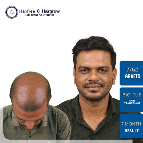 hair-transplant-7762-grafts-7-month-result-pune.jpg